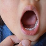 子どもにできる口内炎の種類と原因は？口内炎を予防する方法についても解説！